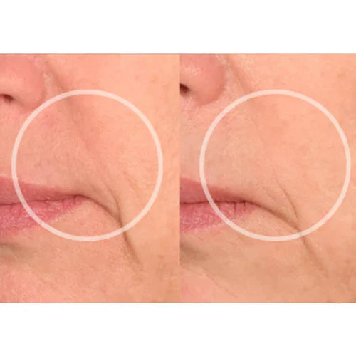 Dermessence® Anti-Wrinkle Mouth Patch