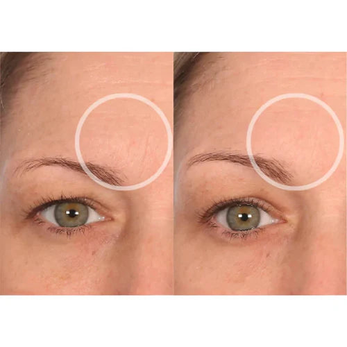 Dermessence® Anti-Wrinkle Forehead Patch